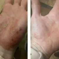 بهبود تمام مشکلات پوستی اگزما و پیسی و ...