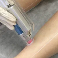 لیزر‌ الکس مو زائد شاتی بدون ژل با سری شخصی