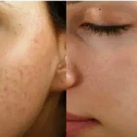 تخفیف ده روزه فیشیال تخصصی