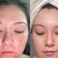 پاکسازی پوست سیار در محل شما