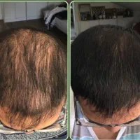 یه خبر خوش دارم برای ریزش موهاتون