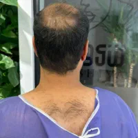 فصد خون ، حجامت و بادکش   در مطب