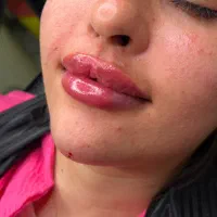 مدل زیباجوی نیازمندیم تزریق لب رایگان ۱۰ نفر