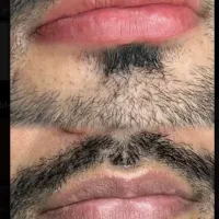 رفع تیرگی لب آقایان - اصلاح رنگ طبیعی لب
