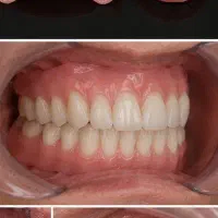 دندانسازی/لثه نرم/دندان مصنوعی/ژله ای اوردنچر/بیمه