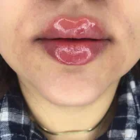 تزریق ژل لب و بوتاکس مزو تراپی سر و صورت  و درمان