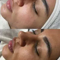 پاکسازی پوست فشیال