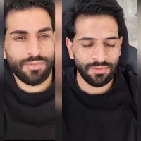 میکرو بلیدینگ، اقایان