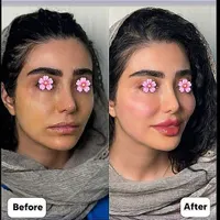 بوتاکس ژل ساکشن چربی جراحی بینی در کلینیک بهنود|خدمات آرایشگری و زیبایی|تبریز, |دیوار