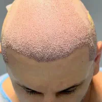 کاشت مو طبیعی تضمینی|خدمات آرایشگری و زیبایی|اصفهان, مرداویج|دیوار