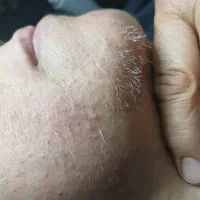 حذف موهای صورت سفید ومشکی الکترولیز