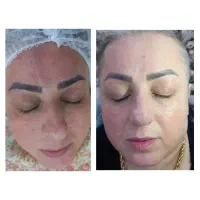 پاکسازی پوست / همراه با دستگاه میکرودرم آبریژن