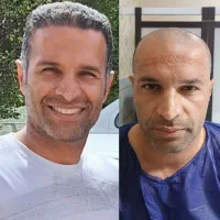 کاشت مو و ابرو