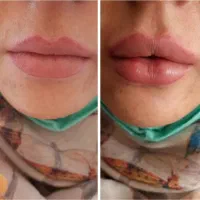 ده سال سابقه کاری ژل بوتاکس مزوسر هیرفیلر پیرسینگ