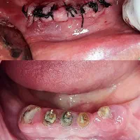 جراحی ریشه دندان و کشیدن