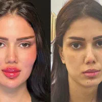 استخوانی یا پر کردن چهره چربیسوز غبغب تک جلسه