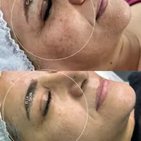 فیشیال پاکسازی و درمان تضمینی پوست|خدمات آرایشگری و زیبایی|کرمانشاه, |دیوار