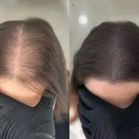 پرپشتی تضمینی موبا میکرواسکالپ/اسکالپ(آموزش/اجرا)