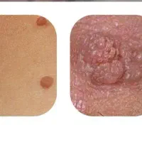 درمان ریشه‌ای/HPV و زائده توی ۱۴ روز
