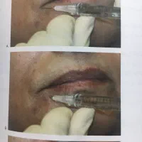 اموزش تزریق ژل وبوتاکس