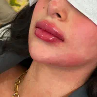 آف ژل و بوتاکس فردا فقط