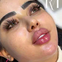 ژل وبوتاکس حرفه ای وتخصصی(مطب)