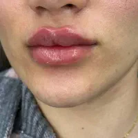 جشنواره تزریق فیلر نورامیس تک سیسی فقط۴.۵