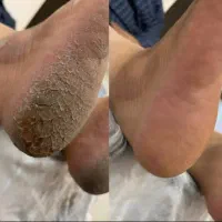کفسابی پدیکور درمان ترک،خشکی ترمیم کاشت ناخن ژلیش