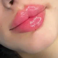 ژل بوتاکس زیبایی