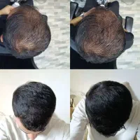 راه حل مشکل کم مویی