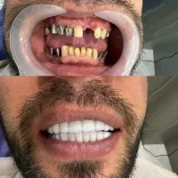 کاشت دائم  ایمپلنت دندان  یازده میلیون تومان