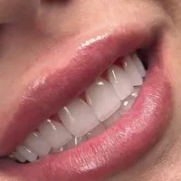 لمینت،روکش،عصبکشی،جرمگیری،کشیدن دندان