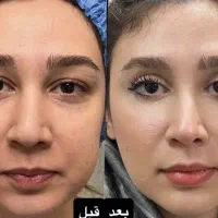 کلینیک تخصصی بلفارو پلاستی عمل رفع افتادگی پلک