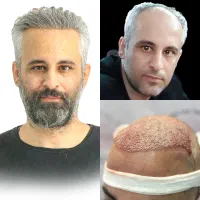 کاشت مو میکروسکوپی - VIP با شرایط اقساطی