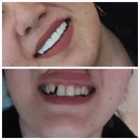 کامپوزیت زیبایی دندان