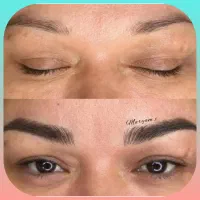شیدلب،بن مژه،میکرو بلیدینگ
