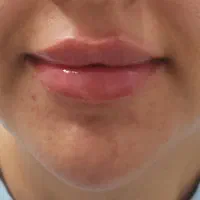 آموزش تزریق ژل لب ویژه مبتدی