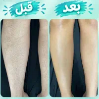 لیزر مو زائد مادام العمر و تضمینی مایا بیوتی