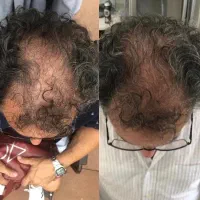 بدون نیاز به کاشت این نتیجه رو بگیر