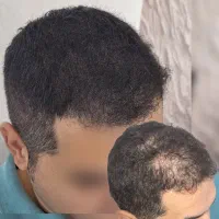 رفع کم پشتی مو / میکرواسکالپ