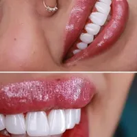 دندانپزشکی اقساطی  عصب کشی . کامپوزیت و...|خدمات آرایشگری و زیبایی|قم, عمار یاسر|دیوار