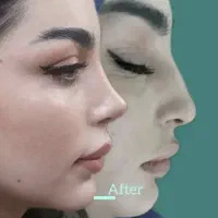 جراحی زیبایی بینی فقط با۲۹میلیون کلینیک تخصصی