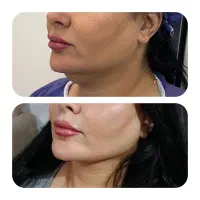دایرکت ابرو و لیپوفیس