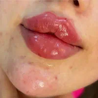 تزریق ژل متدروز۱۲۰۰