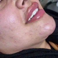 تخفیف ویژه  فیلرلب و .. برند کره ای اصل چکی
