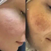 تو ده روز لک هات و از بین ببر