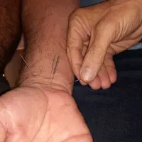 آموزش صفر تا صد طب سوزنی