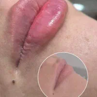 بوتاکس،فیلر لب،جوانسازی و کانتورینگ چهره توسط پزشک