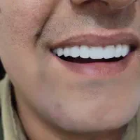 دندانسازی (دندان مصنوعی)پروتز متحرک