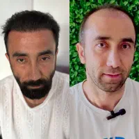 کاشت مو ریش ابرو طبیعی و فول تراکم